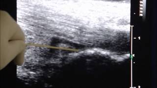 UltrasoundGuided Injection Treatment of Retrocalacaneal Bursitis [upl. by Jecon]