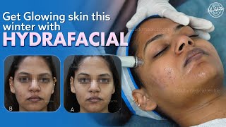 Hydrafacial treatment to cleanse extract and hydrate the skin [upl. by Zeeba387]