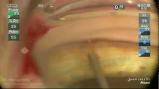 iStent Trabecular MicroBypass Implantation Ike Ahmed [upl. by Scever]