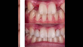 Smile Transformation Replacing Genetically Missing Front Teeth irvinedentist irvine [upl. by Chin]