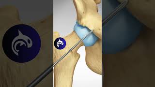 See how a Pincer Impingement of the Hip is repaired  3D Animation [upl. by Rosaline812]