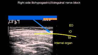 Ultrasound guided right side ilioinguinaliliohypogastric nerve block [upl. by Gilford179]