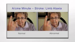 Stroke limb ataxia [upl. by Solegna969]