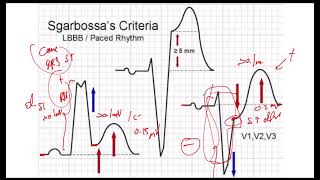 Criterios de Sgarbossa Electro [upl. by Fretwell]