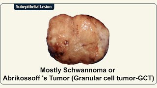 Mostly Schwannoma or Abrikossoff s Tumor Granular cell tumorGCT [upl. by Bowman456]