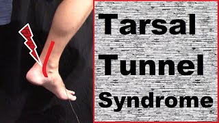 Understanding amp Treating Tarsal Tunnel Syndrome [upl. by Brnaby]