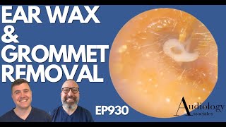 PLASTIC TUBE STUCK IN EAR CANAL  EAR WAX REMOVAL  EP930 [upl. by Ranie248]