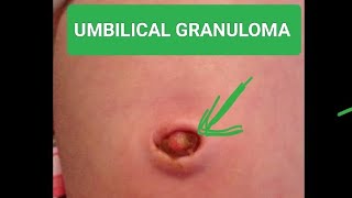 what is umbilical granuloma how to cure it [upl. by Joyann]