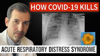 How Coronavirus Kills Acute Respiratory Distress Syndrome ARDS amp COVID 19 Treatment [upl. by Acimehs]