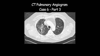 CT Pulmonary Angiogram  Case 6 Part 3 radiologist radiology angiogram pathological [upl. by Balthasar]