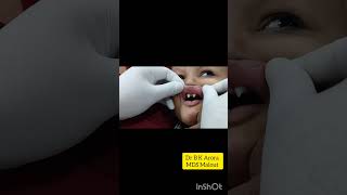 Ectodermal Dysplasia Syndrome dentistdentistnearby [upl. by Hook]