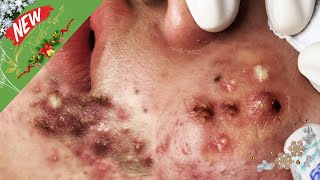 Blackheads amp Acne Treatment Hottest Videos 128 [upl. by Ahsel964]