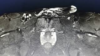 Osteitis pubis  MRI findings [upl. by Avigdor853]