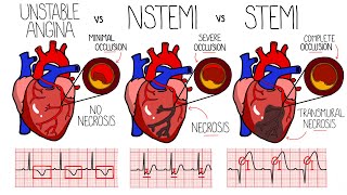 Acute Coronary Syndrome Heart Attack  Unstable Angina vs NSTEMI vs STEMI  With ECGs [upl. by Morehouse]