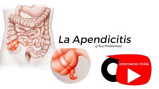 La Apendicitis  ¿Que es Informacion Vivida [upl. by Alded]