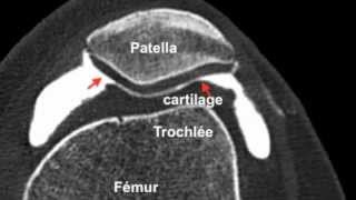 Chondropathierotule3D Arthroscanner [upl. by Tija]