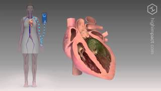 Endocarditis  Proper Antibiotic [upl. by Teerprug]