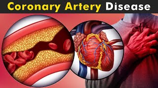 How Coronary Artery Disease Work  Symptoms Causes And Treatment UrduHindi [upl. by Annah]