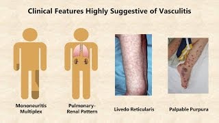 Vasculitis  An Overview [upl. by Aicatsal]