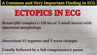 ECG Ectopics Explained  Learn about Ectopics APCs amp VPCs  Ventricular Trigeminy ECG [upl. by Eldon]