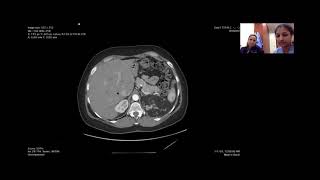 Aggressive Renal Angiomyolipoma Nelly Tan [upl. by Akcimat]