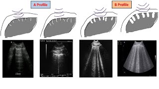 Lecture 4 Lung US in interstitial syndrome [upl. by Akienat]