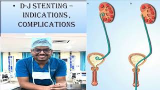 DJ STENTING  UNEDITED STEP BY STEP PROCEDURE INDICATIONS amp COMPLICATIONS [upl. by Ferdie]