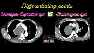 ESOPHAGEAL DUPLICATION CYST VS BRONCHOGENIC CYST [upl. by Nesahc]