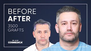 Hair Transplant in Turkey  Results  Dr Acar  Cosmedica Clinic [upl. by Aan]