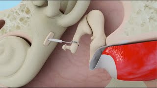 Stapedotomy Animation to Treat Otosclerosis Curable Type of Hearing Loss [upl. by Atalaya874]