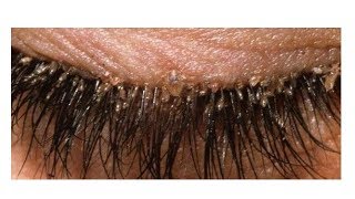 We all have mites in the eyelashes and heres how to get rid of them [upl. by Juxon]