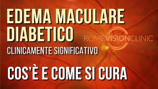 Edema maculare diabetico clinicamente significativo CSME [upl. by Cox]