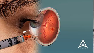 How Macular Degeneration Affects Your Vision  3D animation [upl. by Nailimixam]