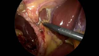 Laparoscopic cholecystectomy [upl. by Schmeltzer]