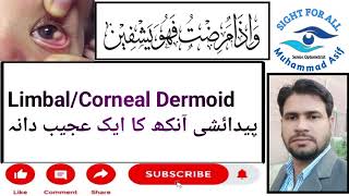 LimbalCorneal DermoidAnkho ka Paidaishi Ajeeb Dana [upl. by Aretak]