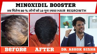 Minoxiboost Minoxidil Booster For Hair Growth  New Hair Research  10x More Result  Hair Loss [upl. by Benedick472]