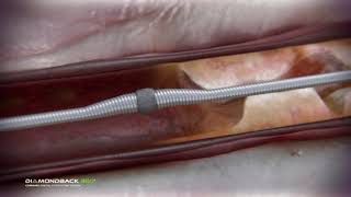 Coronary Orbital Atherectomy [upl. by Neetsyrk]