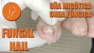 Fungal nail Podología Integral [upl. by Sharp]