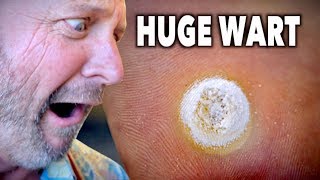 HUGE DECAYING WART Frozen With Liquid Nitrogen  Dr Paul [upl. by Creath]