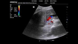 ultrasound portal vein thrombosis [upl. by Jeminah703]