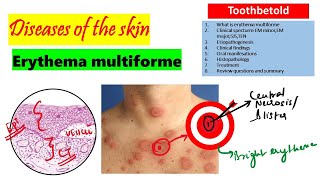 Erythema Multiforme  Etiology Clinical features Histopathology treatment [upl. by Acul17]