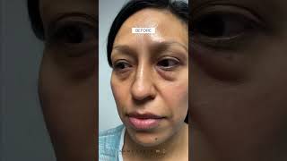 Quadfecta Lift with Dr Parsa  Ethnic Skin Tone  2 Months PostOp [upl. by Ynottirb]