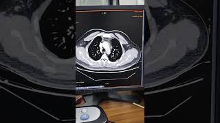 What Is A Pulmonary Angiographyradiologytechnologist radiological ctscan angiography mr [upl. by Hephzipa]