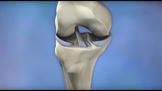 ACL Injury Prevention  Mayo Clinic [upl. by Castorina]