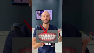 Deep Bite Correction with Invisalign 2024 [upl. by Fredia331]