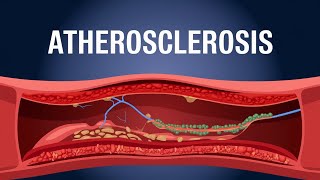 Atherosclerosis animation understanding Atherosclerosis [upl. by Witha66]