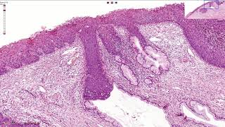 HSIL  High Grade Squamous Intraepithelial Lesion  Histopathology [upl. by Otha686]