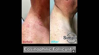 Eosinophilic Folliculitis [upl. by Bandeen692]