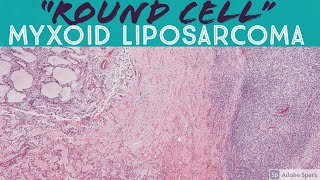 quotRound cellquot High Grade Myxoid Liposarcoma [upl. by Noisla807]