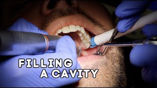 How Does A Dentist Fill A Cavity [upl. by Lori]